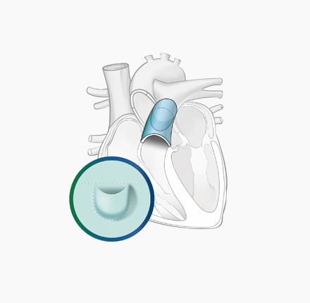 Outflow Tract Single Valve Patch