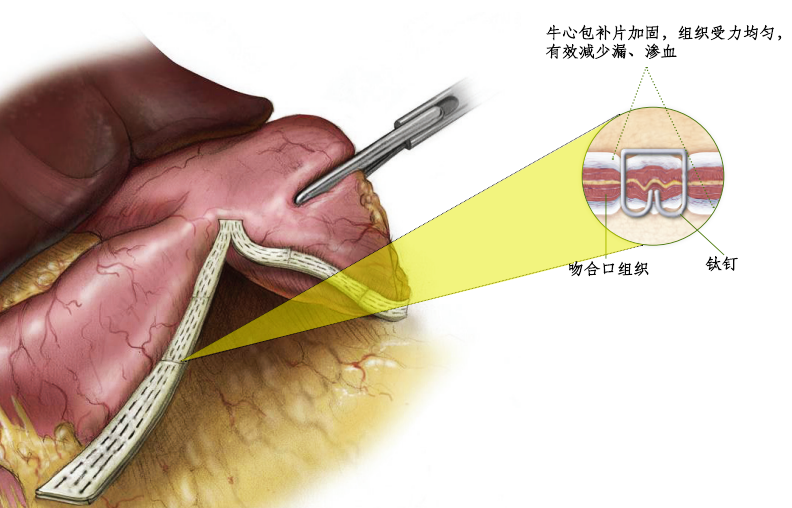 防渗漏，促愈合-佰仁医疗消化外科生物补片注册临床试验入组正式完成